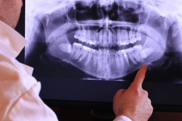 Best Emergency Tooth Extraction in Panhandle, TX